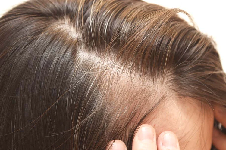 Our Guide To Hair Thinning | RPR Hair Care